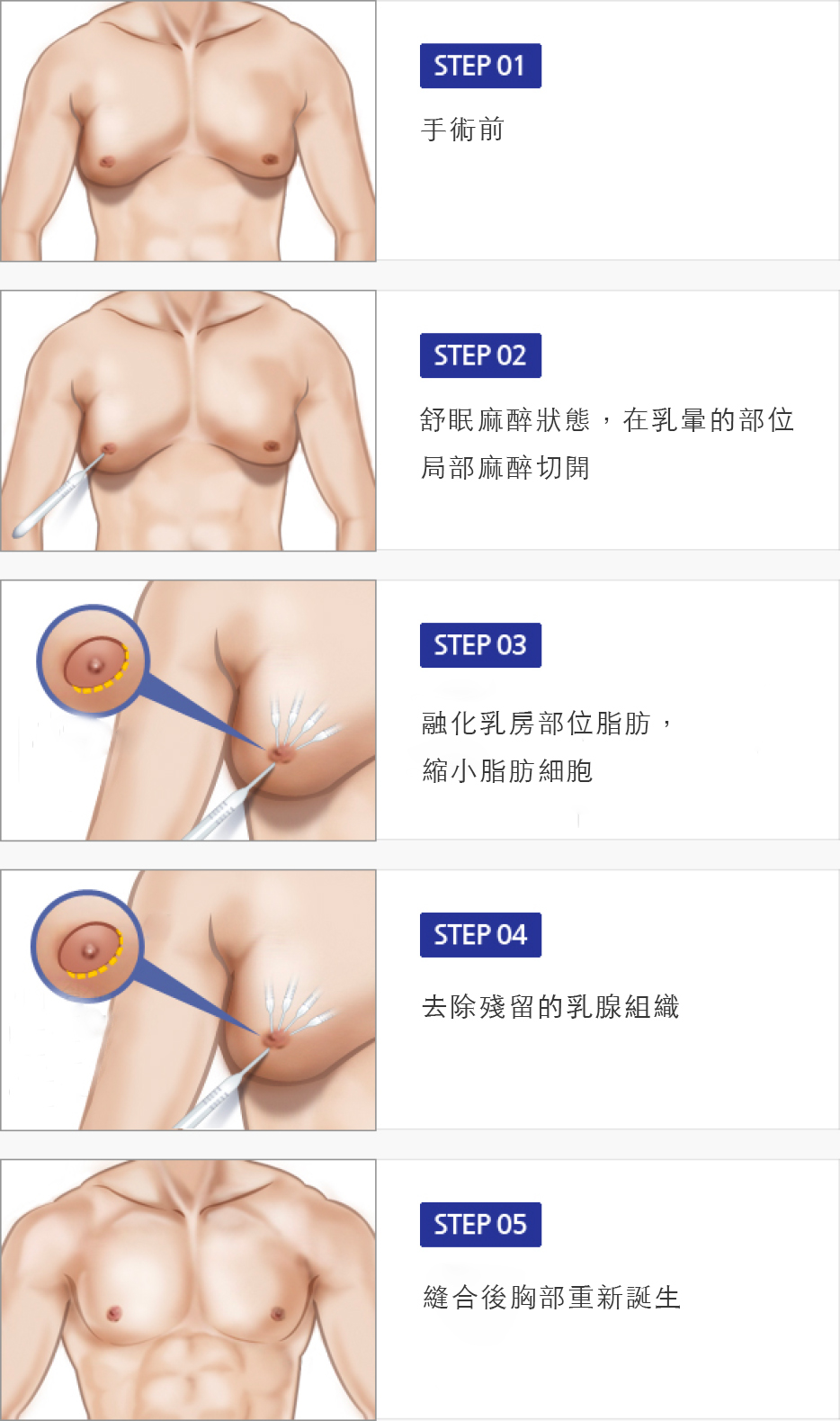 乳腺 肥大 症 女